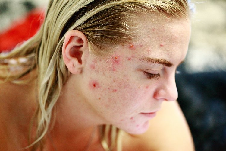https://www.ragusanews.com/immagini_articoli/13-09-2019/acne-gli-alimenti-per-una-dieta-corretta-500.jpg