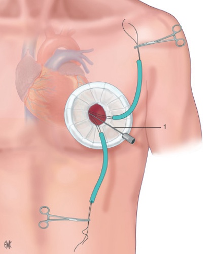 https://www.ragusanews.com/immagini_articoli/19-02-2025/chirurgia-vascolare-a-vittoria-il-primo-intervento-di-posizionamento-di-endoprotesi-in-aorta-toraci-500.jpg